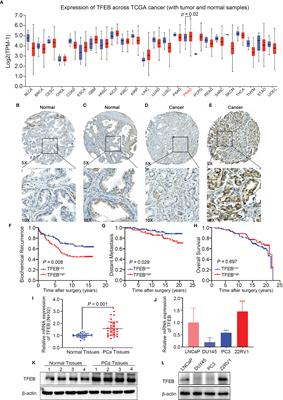 TFEB Promotes Prostate Cancer Progression via Regulating ABCA2-Dependent Lysosomal Biogenesis